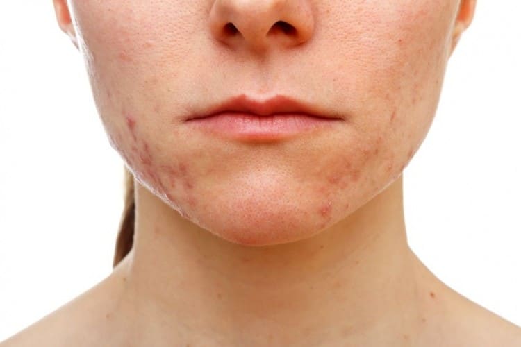 Acne, nutrizione e stile di vita