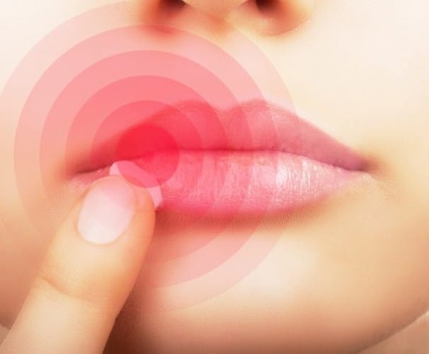 Herpes e afte: come potenziare il sistema immunitario?