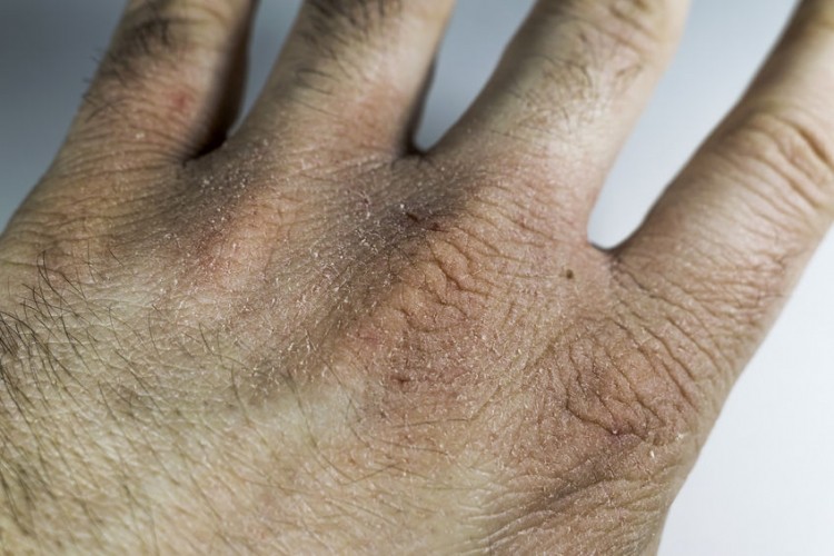 Mani fissurate, ragadi e dermatite: l'intreccio tra nichel, freddo e vitamina D3