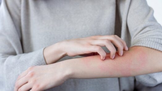https://www.eurosalus.com/wp-content/uploads/2023/10/Orticaria-cronica-quando-serve-qualcosa-in-piu_articleimage-5-524x295.jpg