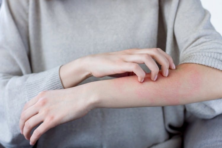 Orticaria cronica: quando serve qualcosa in più