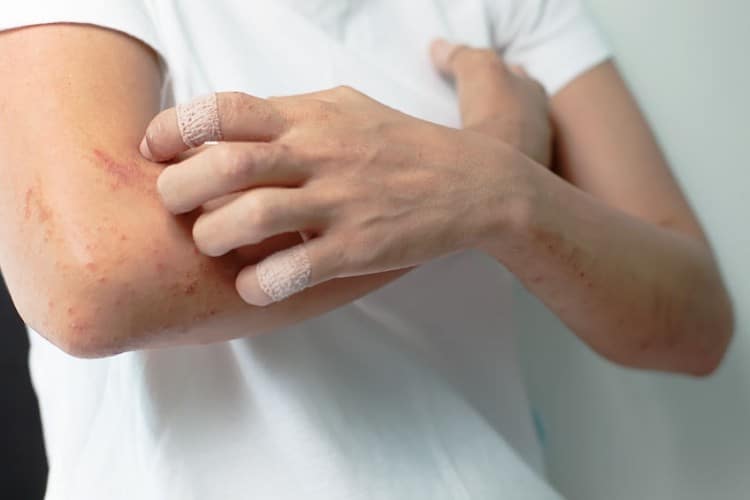 Orticaria e infiammazione da cibo: misurare il BAFF per guarire