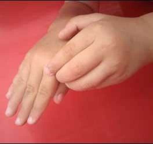 Orticaria: ecco come intervenire naturalmente