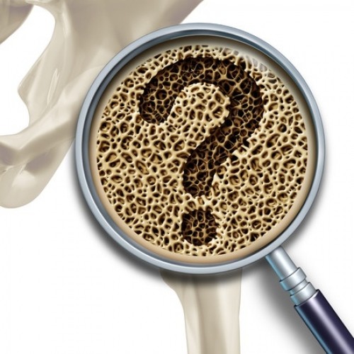 Osteoporosi: e se fossero alterati i parametri di riferimento?