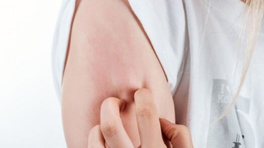 https://www.eurosalus.com/wp-content/uploads/2023/10/Quando-l-orticaria-non-risponde-agli-antistaminici-vanno-studiate-le-citochine-correlate-al-cibo_articleimage-4-524x295.jpg