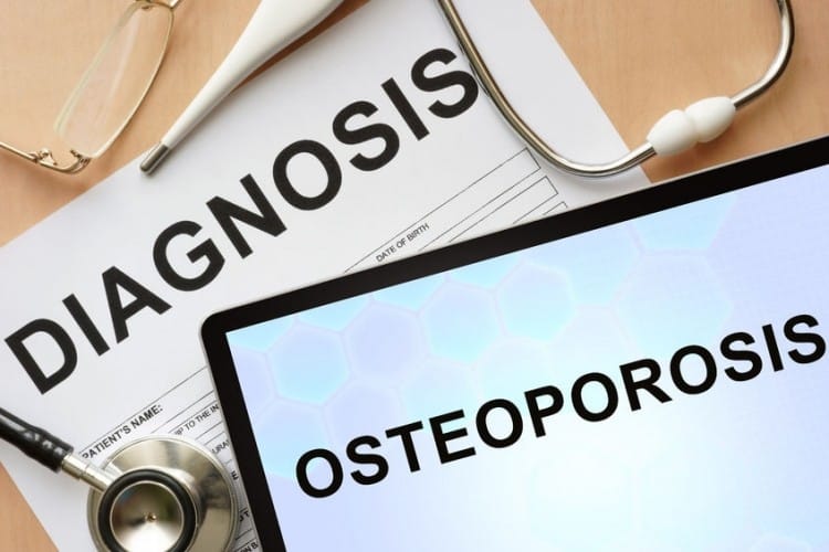 Quando non è vero che hai l'osteoporosi